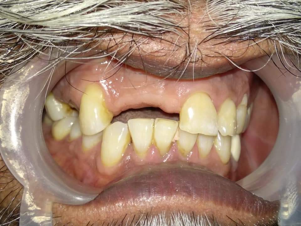 Before treatment