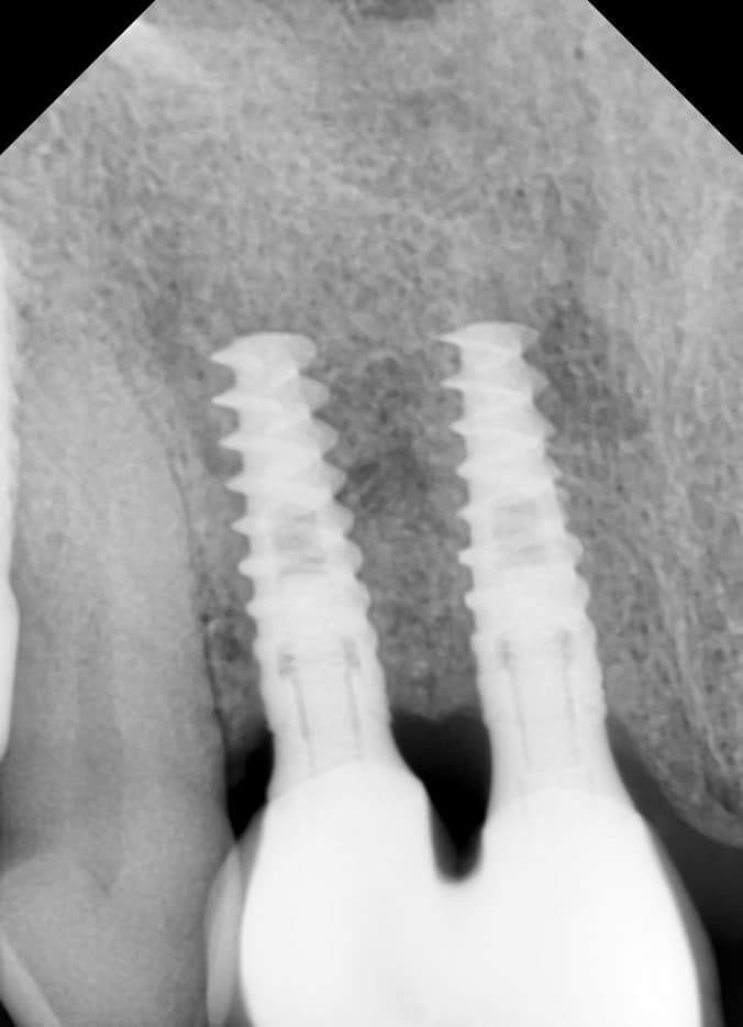 X-ray