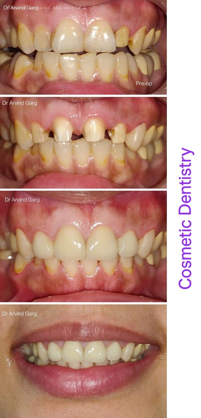 Cosmetic dentistry result