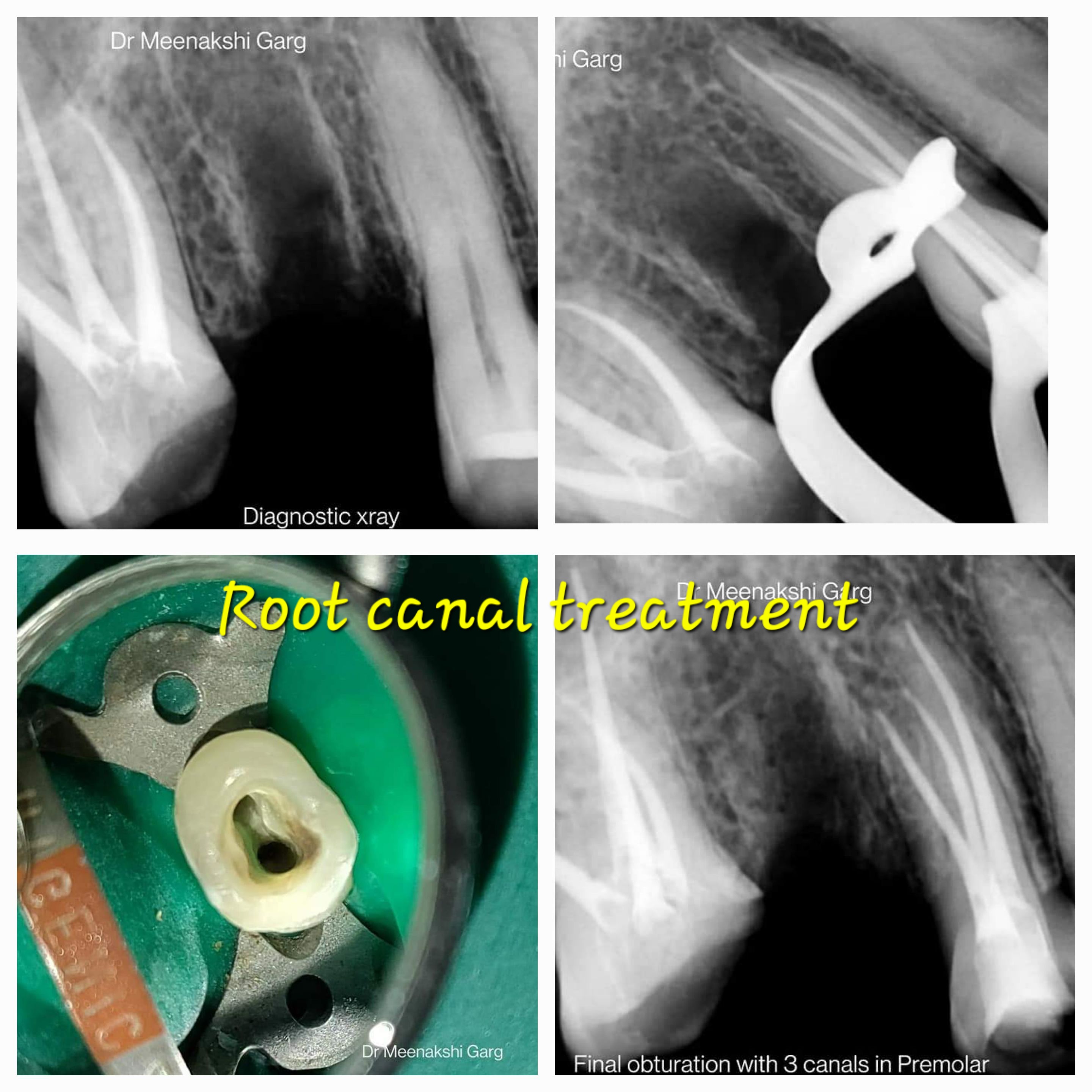 Root canal treatment